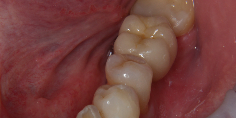  Дентальная имплантация 1 зуба на нижней челюсти, металлокерамическая коронка с опорой на имплант