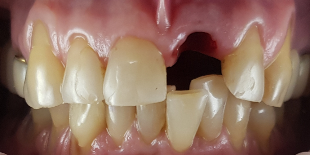  Дентальная имплантация 1 зуба на верхней челюсти, цельнокерамическая коронка с опорой на имплантат