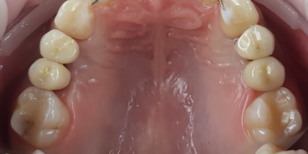  Дентальная имплантация 4х зубов, цельнокерамические коронки на имплантаты