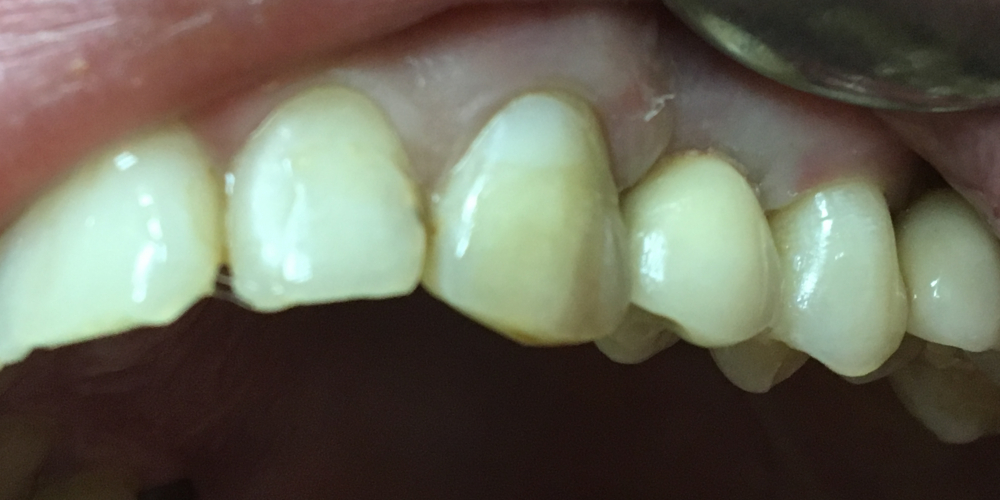  Имплантация с одномоментным удалением корня зуба