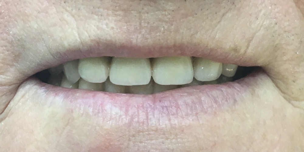  Протезирование с применением имплантатов и сохранением своих зубов