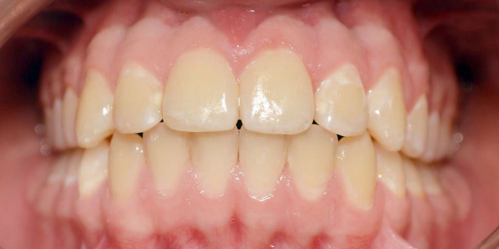  Нейтральное соотношение зубных рядов и апикальных базисов
