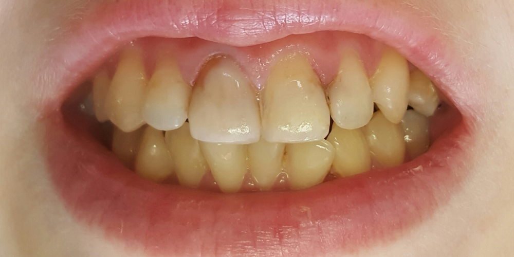  Цельнокерамические винир и коронка E-max на 11, 21 зуб