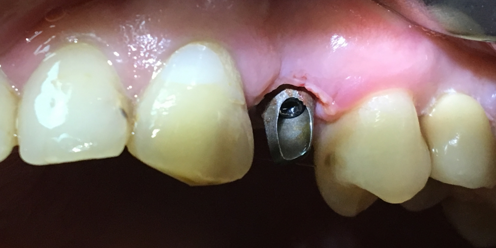  Имплантация с одномоментным удалением корня зуба