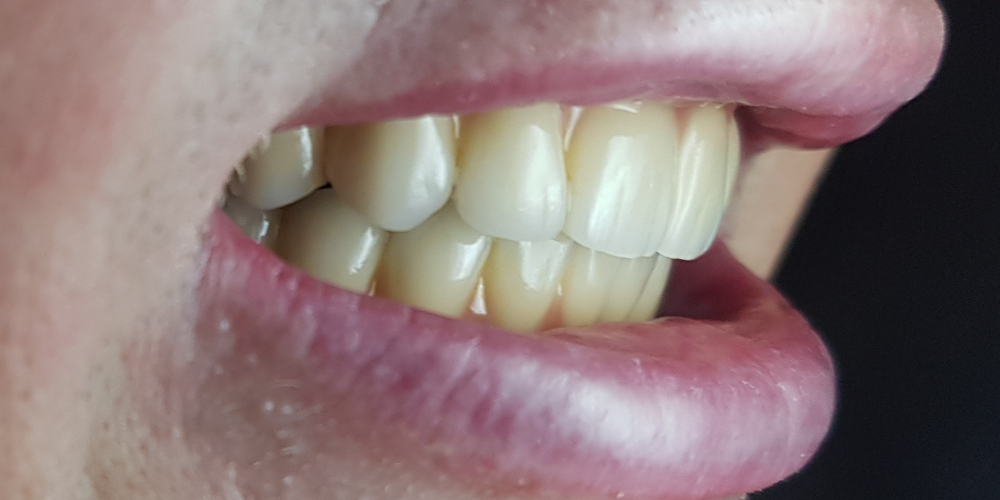  Дентальная имплантация на верхней и нижней челюсти с удалением всех зубов по показаниям