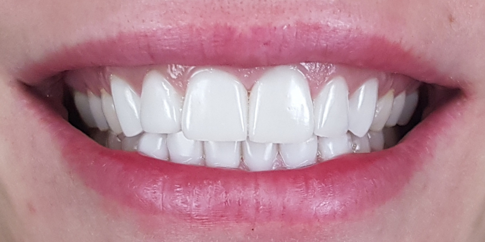  Цельнокерамические виниры E-max на передние зубы верхней и нижней челюсти, домашнее отбеливание