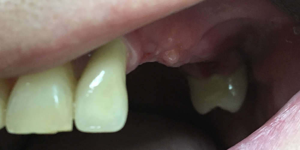  Протезирования боковой группы зубов на верхней челюсти слева на имплантатах