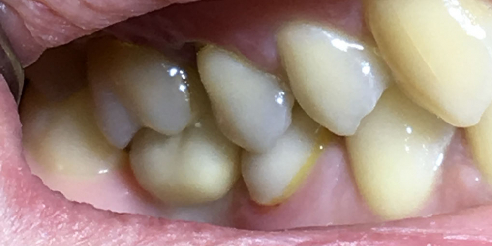  Восстановить жевательную функцию после утраты зуба более года назад