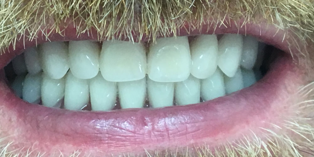 Жалобы на полное отсутствие зубов на верхней и нижней челюсти