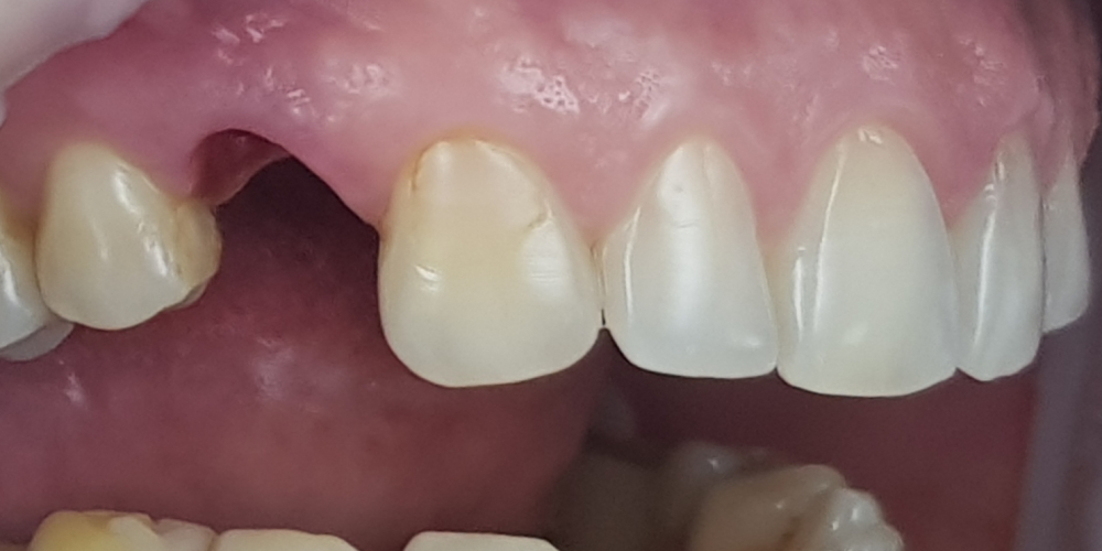  Дентальная имплантация 1 зуба на верхней челюсти, металлокерамическая коронка с опорой на имплантат
