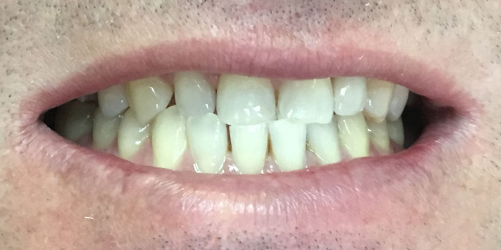  Одномоментная имплантация Osstem переднего зуба