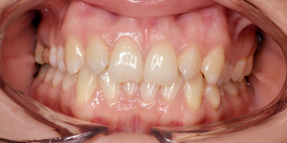  Исправление скученности зубов на верхней и нижней чеюсти