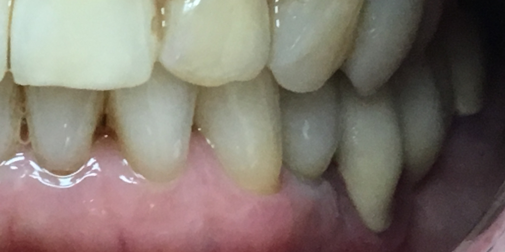  Восстановление отсутствующего зуба имплантатом