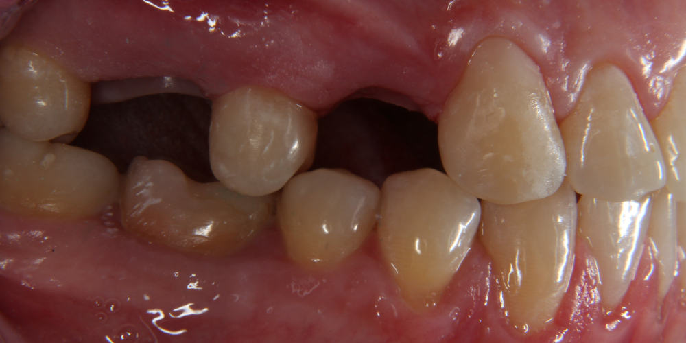  Дентальная имплантация 3х зубов на верхней челюсти