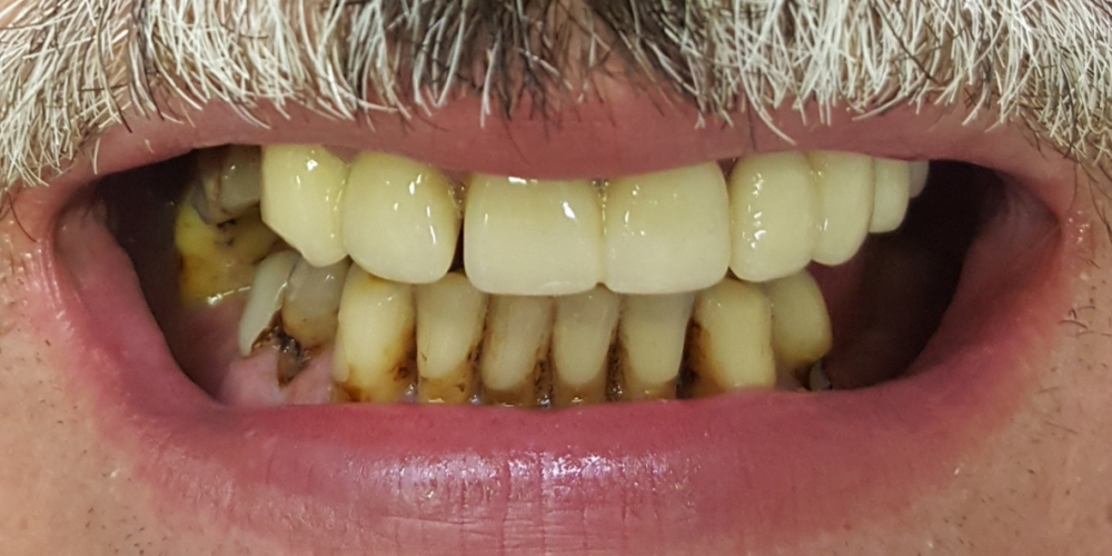  Имплантация зубов верхней и нижней челюсти, полностью