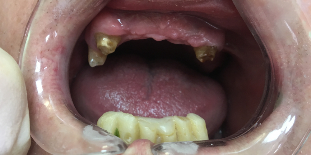  Комплексное восстановление жевательной функции при частичном отстутствии зубов