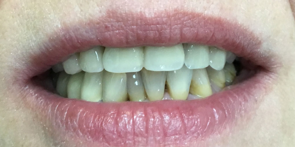  Комплексное восстановление зубов верхней и нижней челюсти