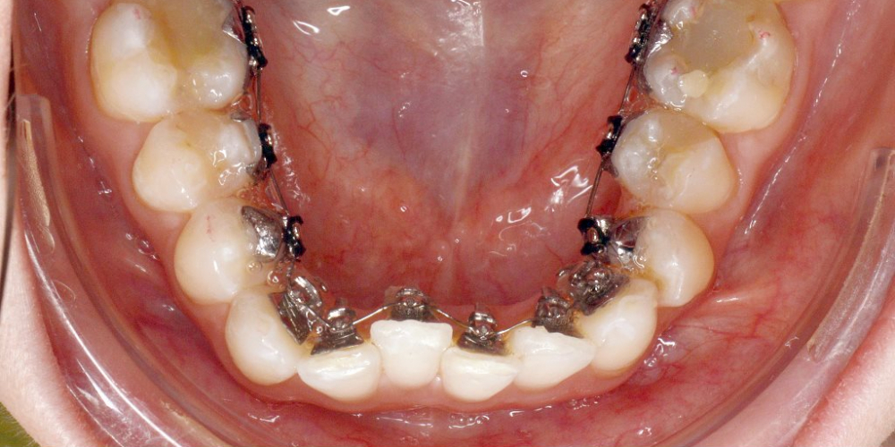  Исправление скученности зубов на верхней и нижней чеюсти