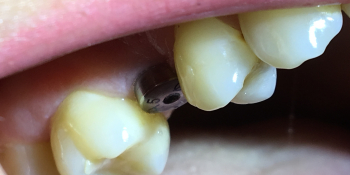 Жалоба на разрушенный корень 15 зуба фото до лечения