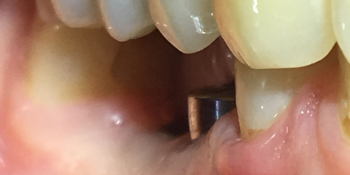 Восстановить жевательную функцию вследствие утраты двух зубов фото до лечения