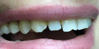 Жалоба на разрушенный корень 15 зуба фото после лечения