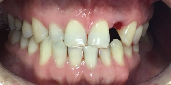Одномоментная имплантация Osstem переднего зуба фото до лечения
