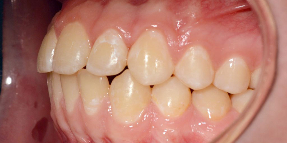  Нейтральное соотношение зубных рядов и апикальных базисов