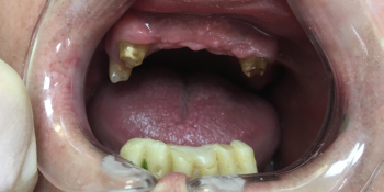 Комплексное восстановление жевательной функции при частичном отстутствии зубов фото до лечения